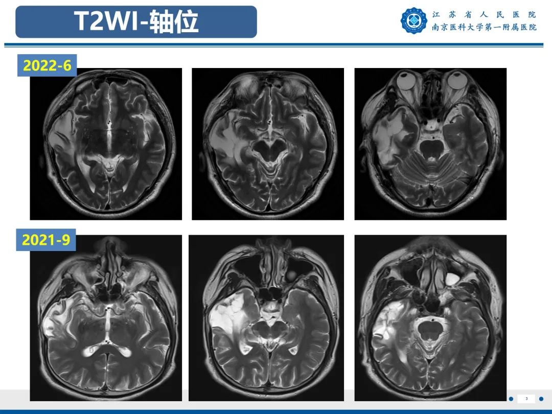 【PPT】​海马硬化-4