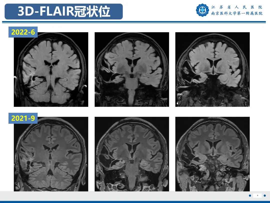 【PPT】​海马硬化-5