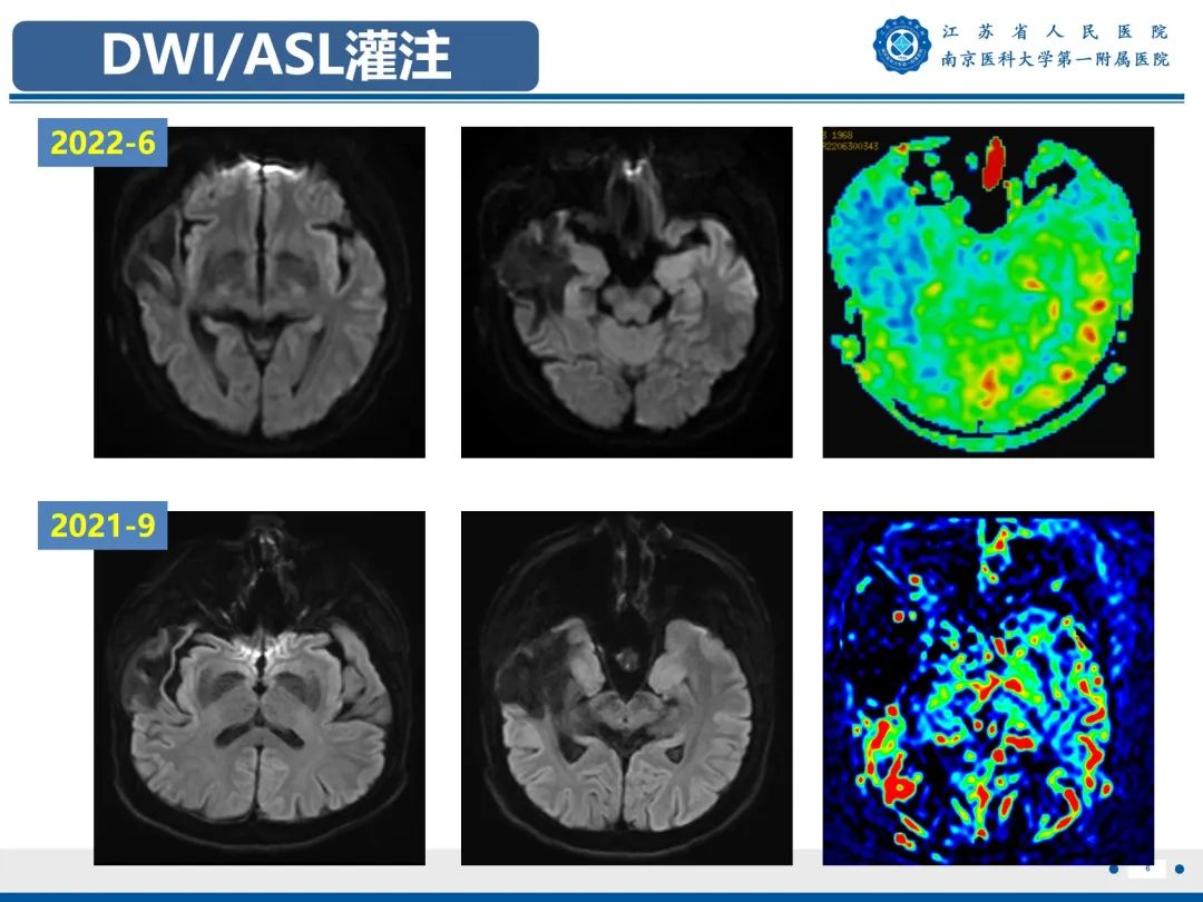 【PPT】​海马硬化-7