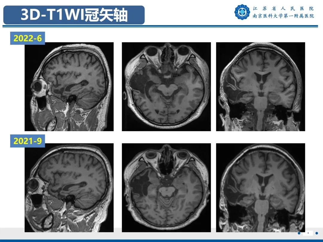 【PPT】​海马硬化-6