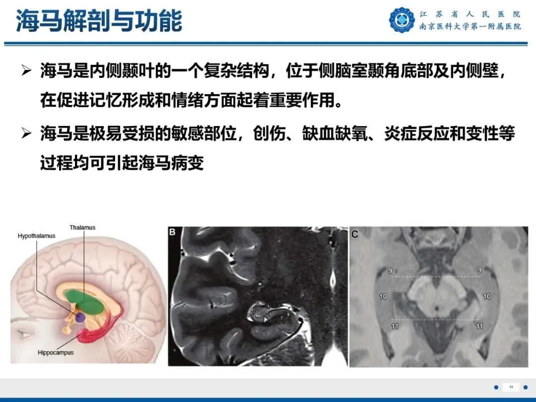 【PPT】​海马硬化-12