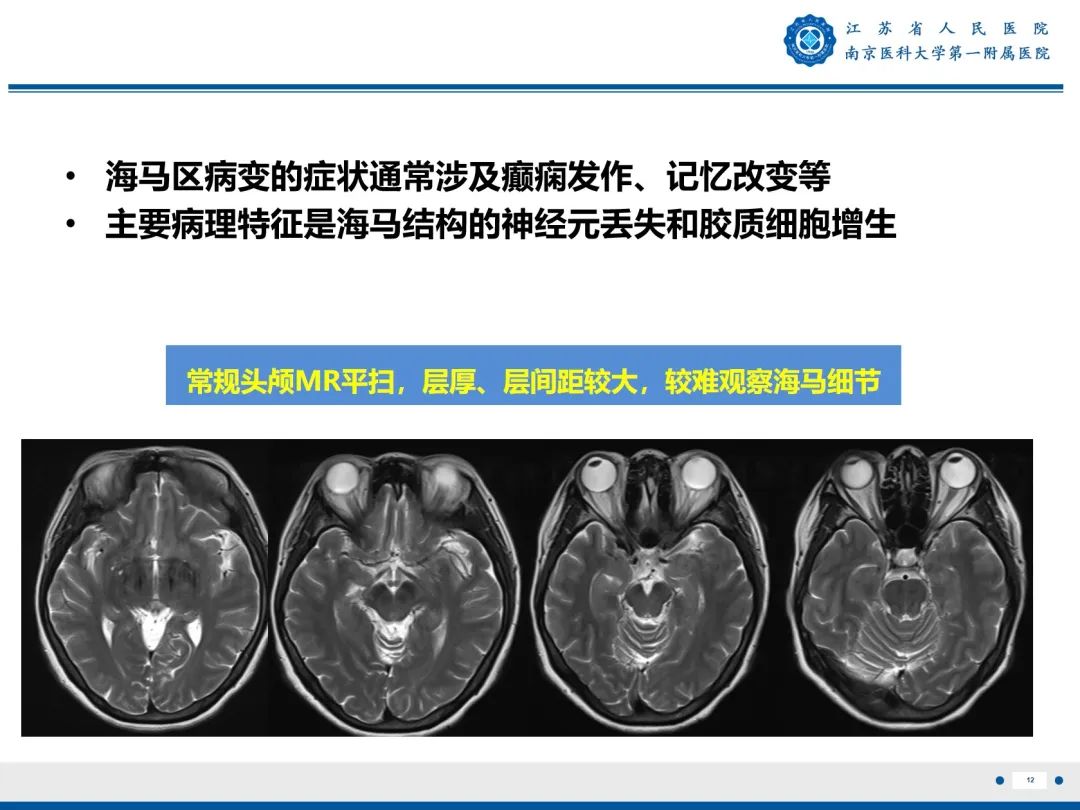 【PPT】​海马硬化-13