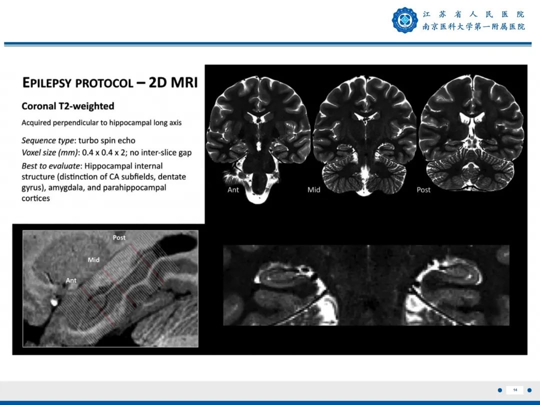 【PPT】​海马硬化-15