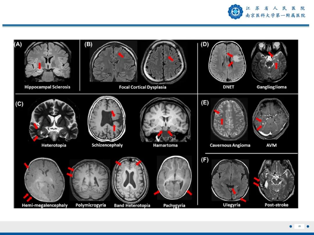 【PPT】​海马硬化-24