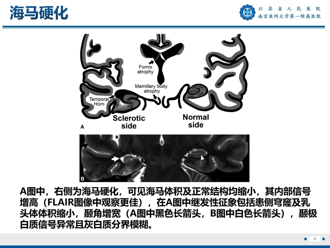 【PPT】​海马硬化-26