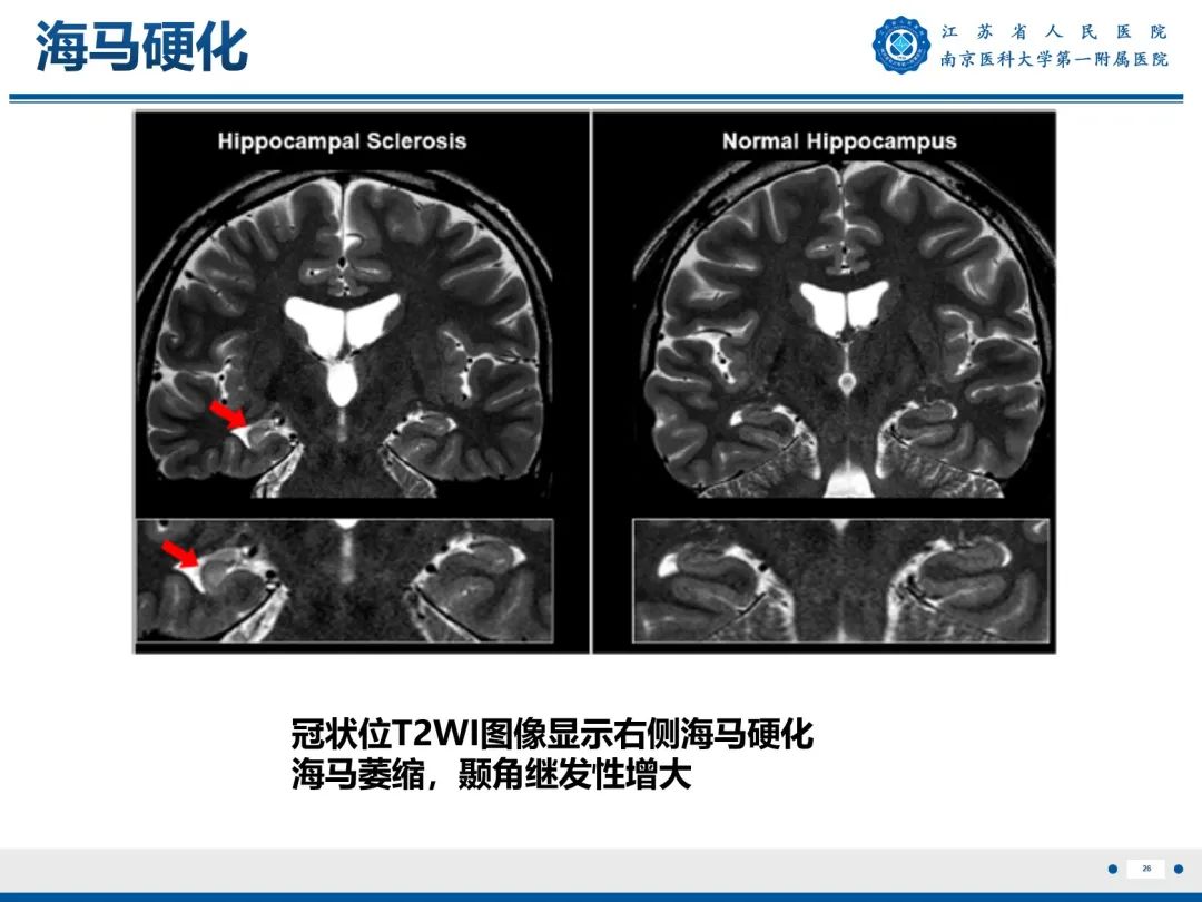 【PPT】​海马硬化-27