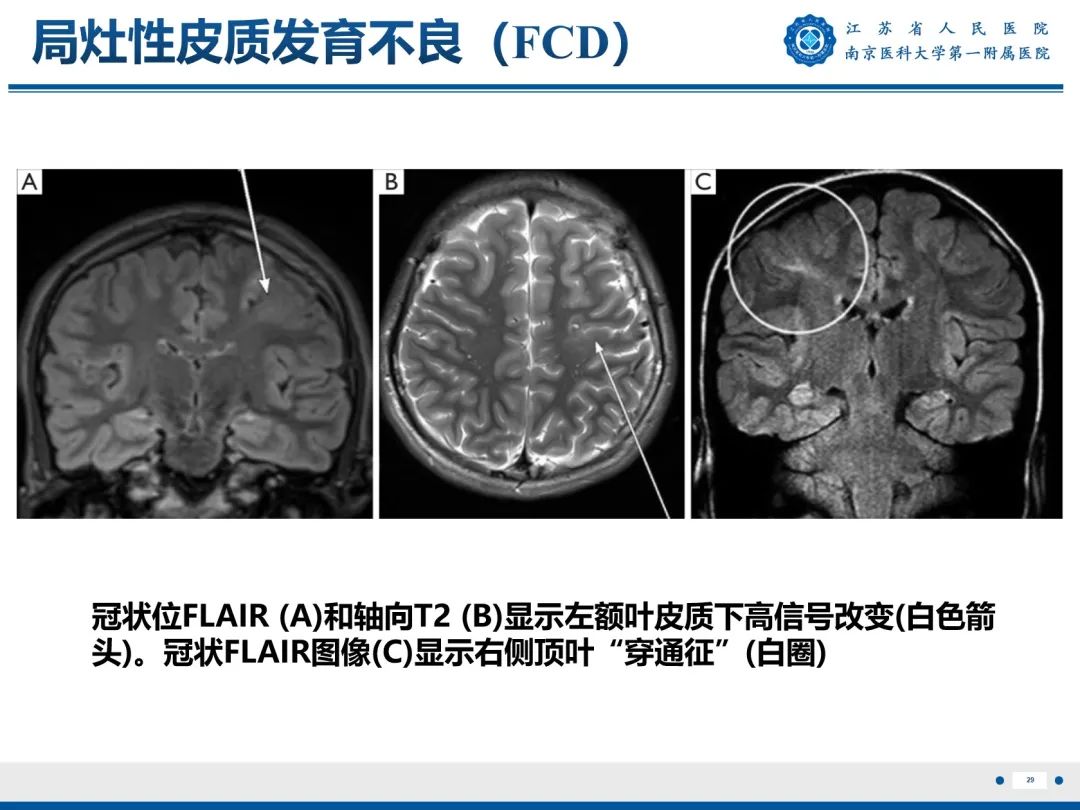 【PPT】​海马硬化-30