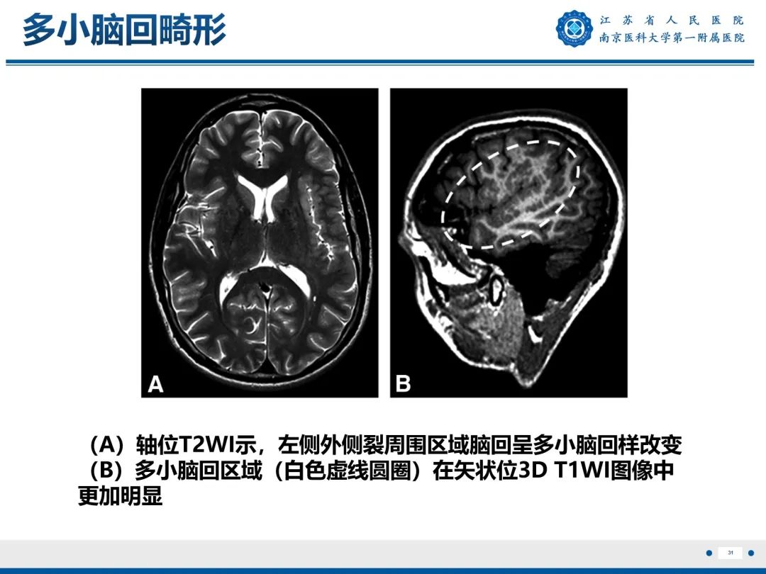 【PPT】​海马硬化-32