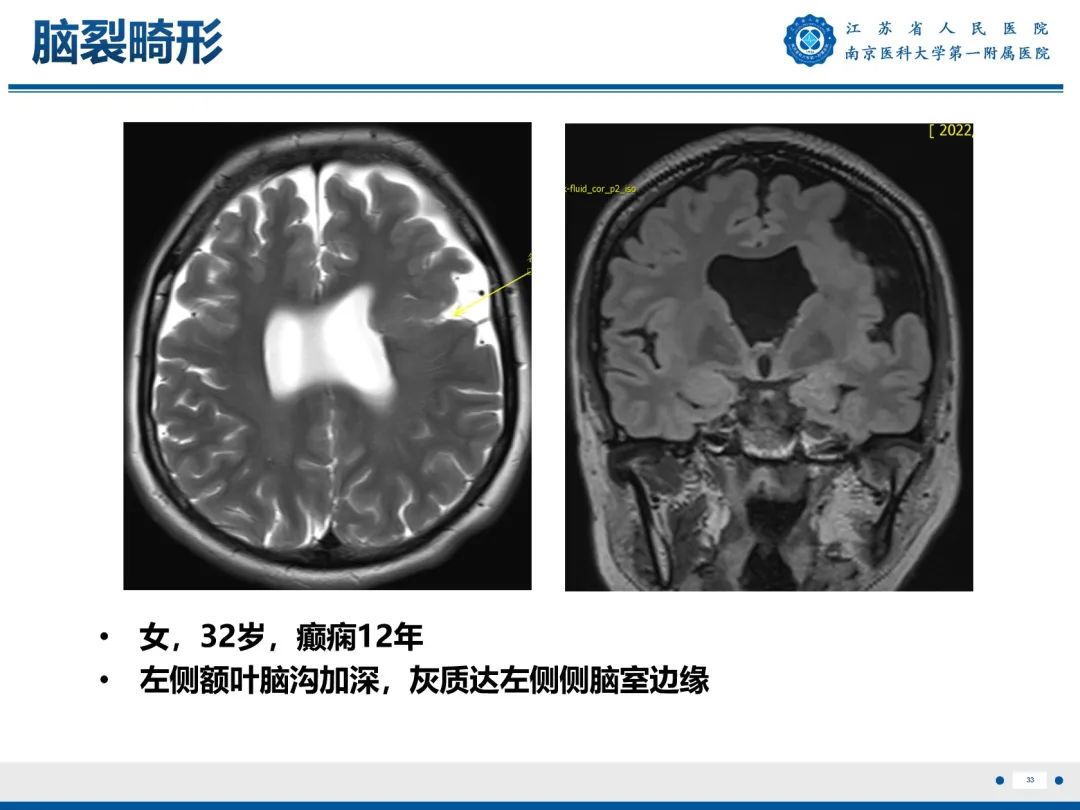 【PPT】​海马硬化-34