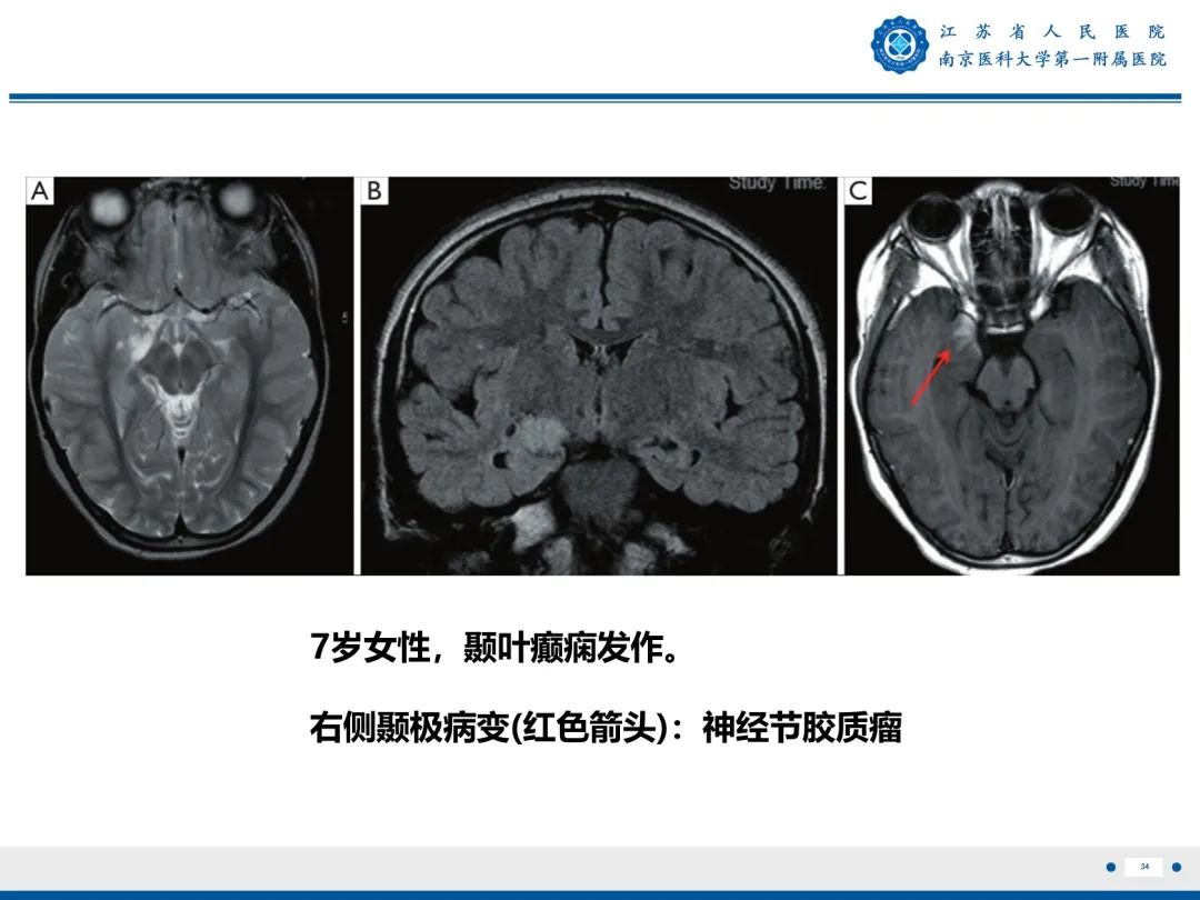 【PPT】​海马硬化-35