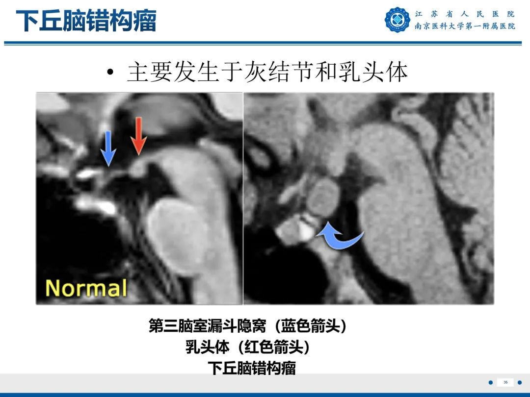 【PPT】​海马硬化-36