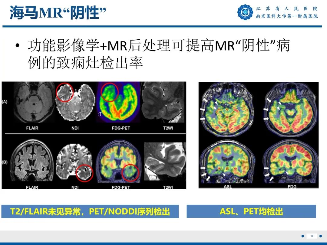 【PPT】​海马硬化-39