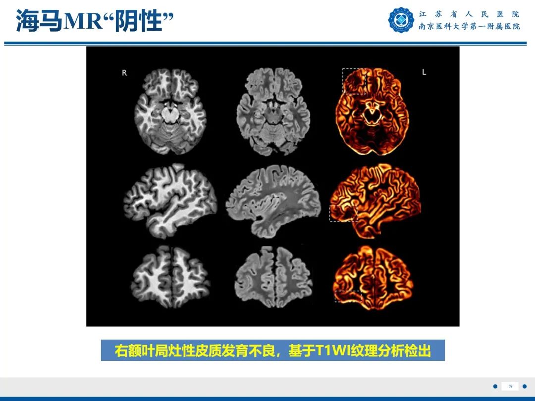 【PPT】​海马硬化-40