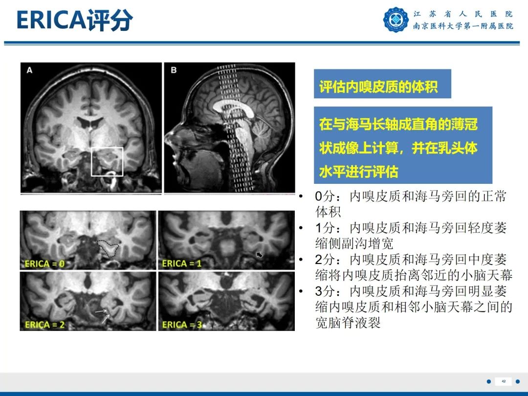 【PPT】​海马硬化-43