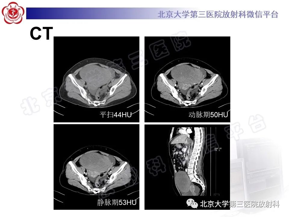 【PPT】卵巢纤维-卵泡膜细胞瘤-3