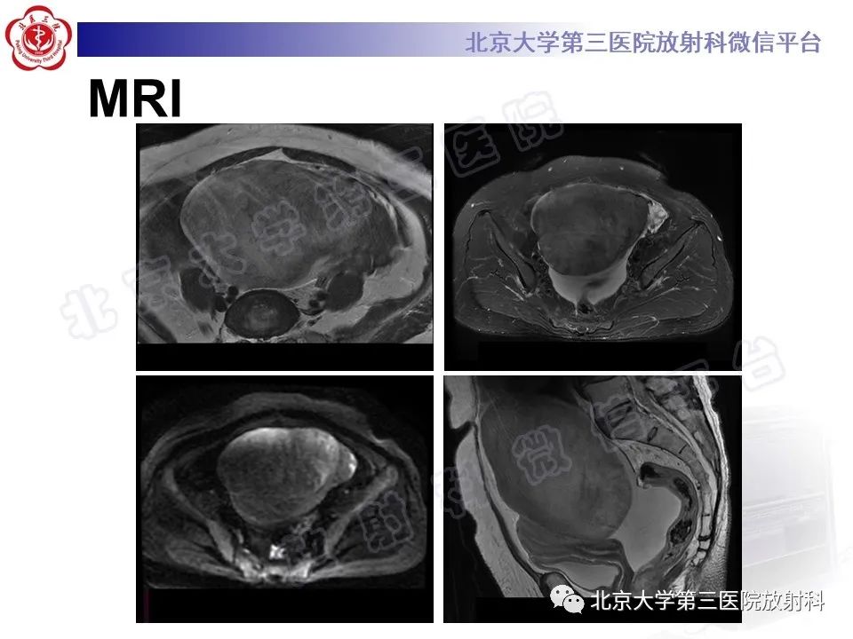 【PPT】卵巢纤维-卵泡膜细胞瘤-4