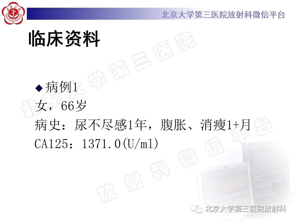 【PPT】卵巢纤维-卵泡膜细胞瘤-2