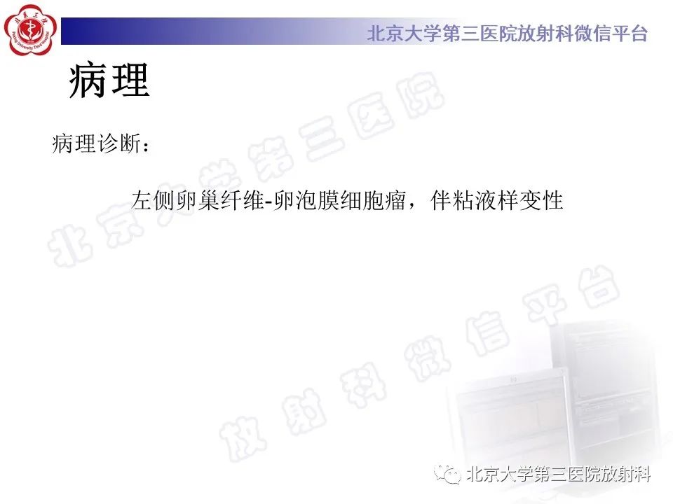 【PPT】卵巢纤维-卵泡膜细胞瘤-7