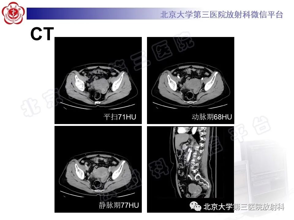 【PPT】卵巢纤维-卵泡膜细胞瘤-9