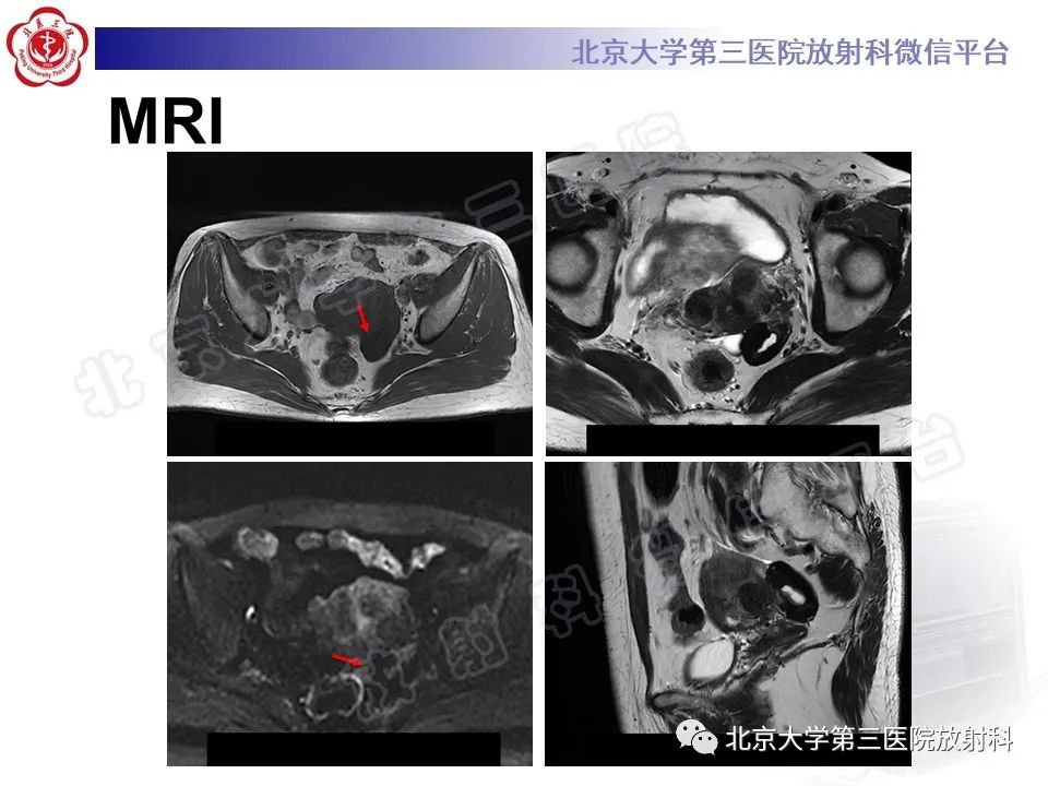 【PPT】卵巢纤维-卵泡膜细胞瘤-10