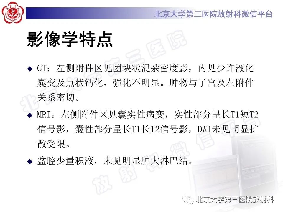 【PPT】卵巢纤维-卵泡膜细胞瘤-11