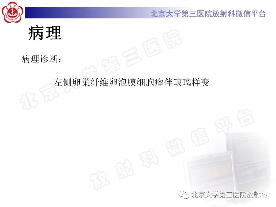 【PPT】卵巢纤维-卵泡膜细胞瘤-13