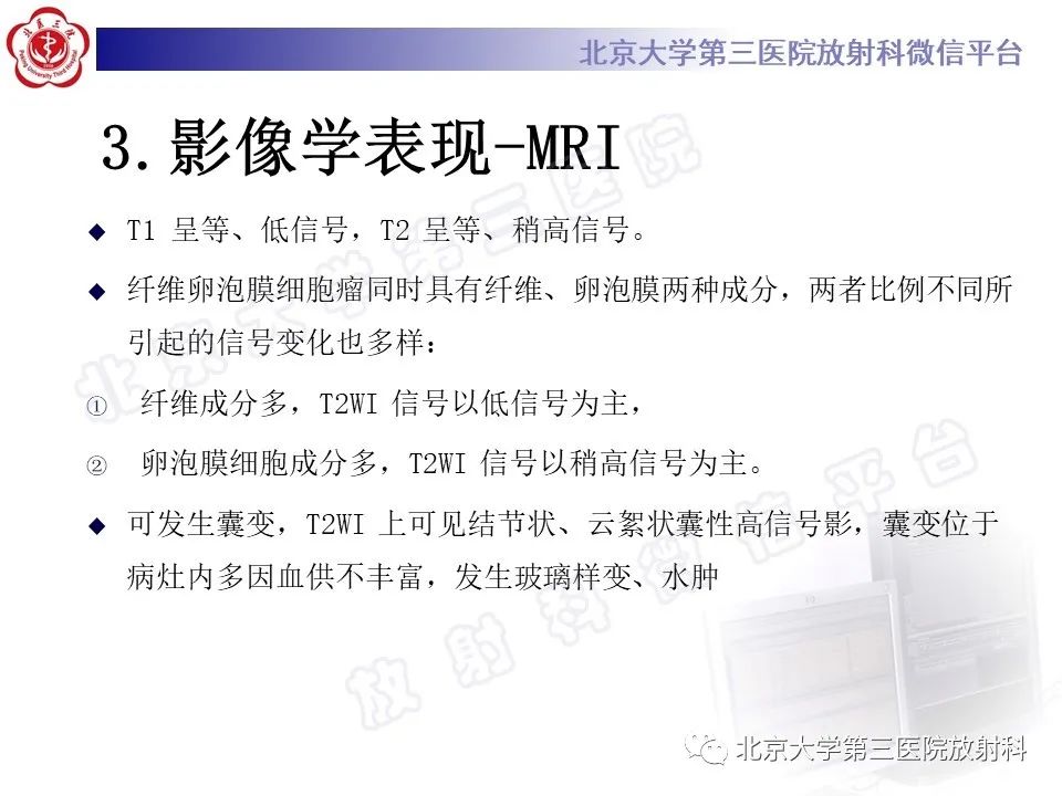 【PPT】卵巢纤维-卵泡膜细胞瘤-18