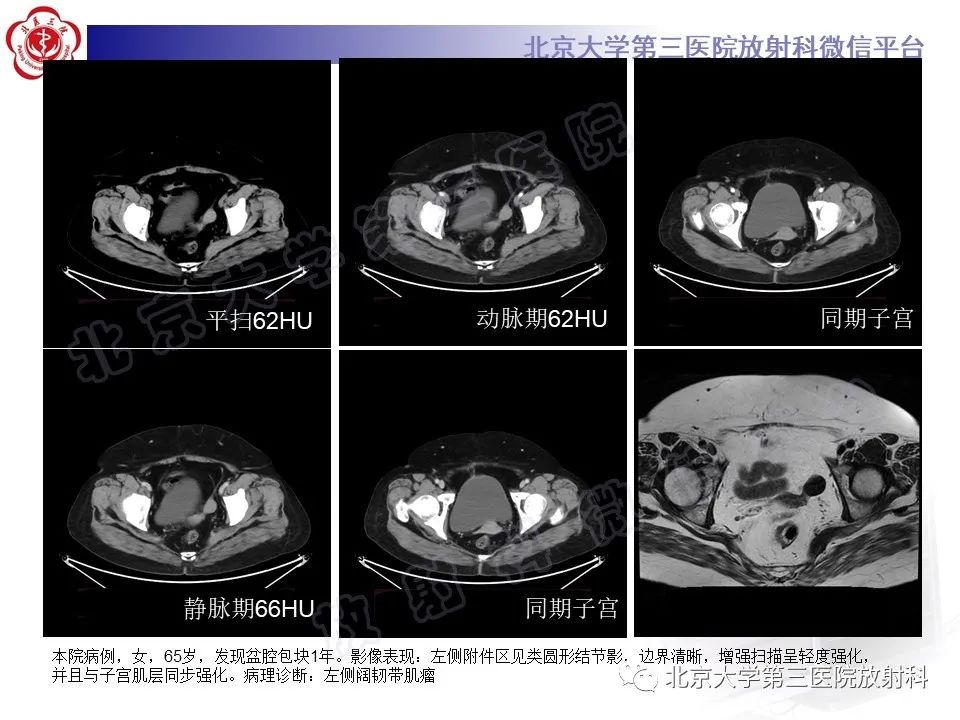 【PPT】卵巢纤维-卵泡膜细胞瘤-20