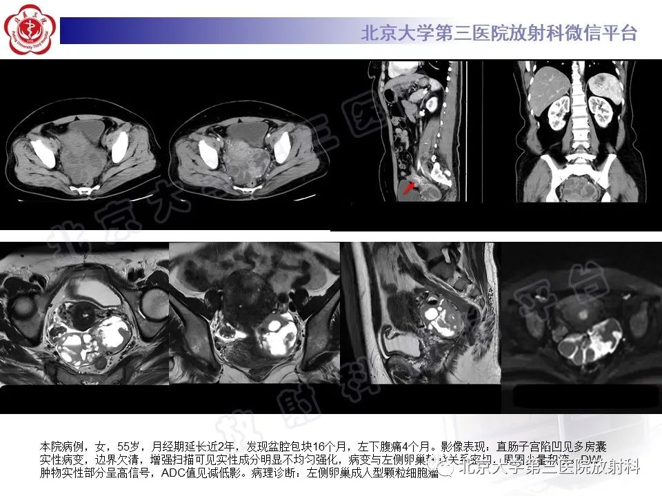 【PPT】卵巢纤维-卵泡膜细胞瘤-22