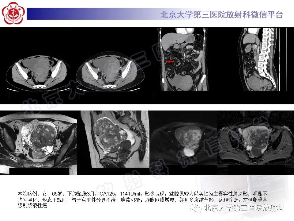 【PPT】卵巢纤维-卵泡膜细胞瘤-24