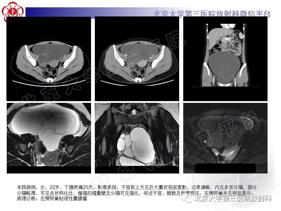 【PPT】卵巢纤维-卵泡膜细胞瘤-25