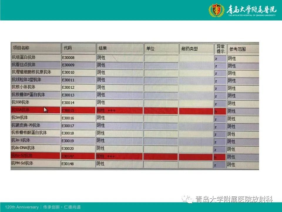 【病例】原发性干燥综合征继发肺淀粉样变性1例CT影像-3