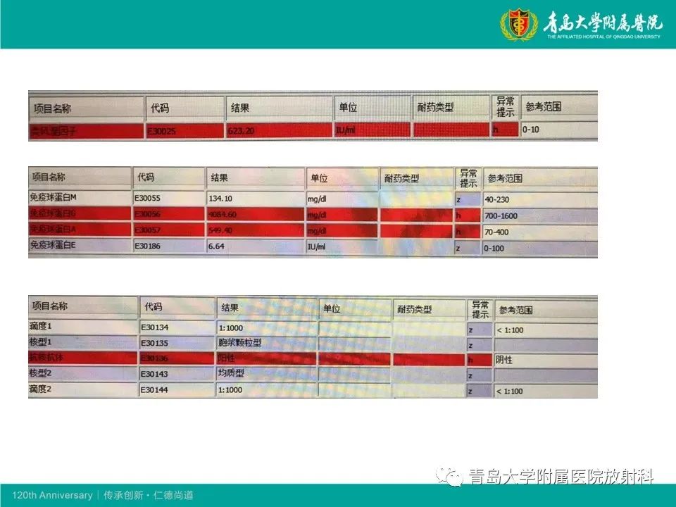 【病例】原发性干燥综合征继发肺淀粉样变性1例CT影像-4