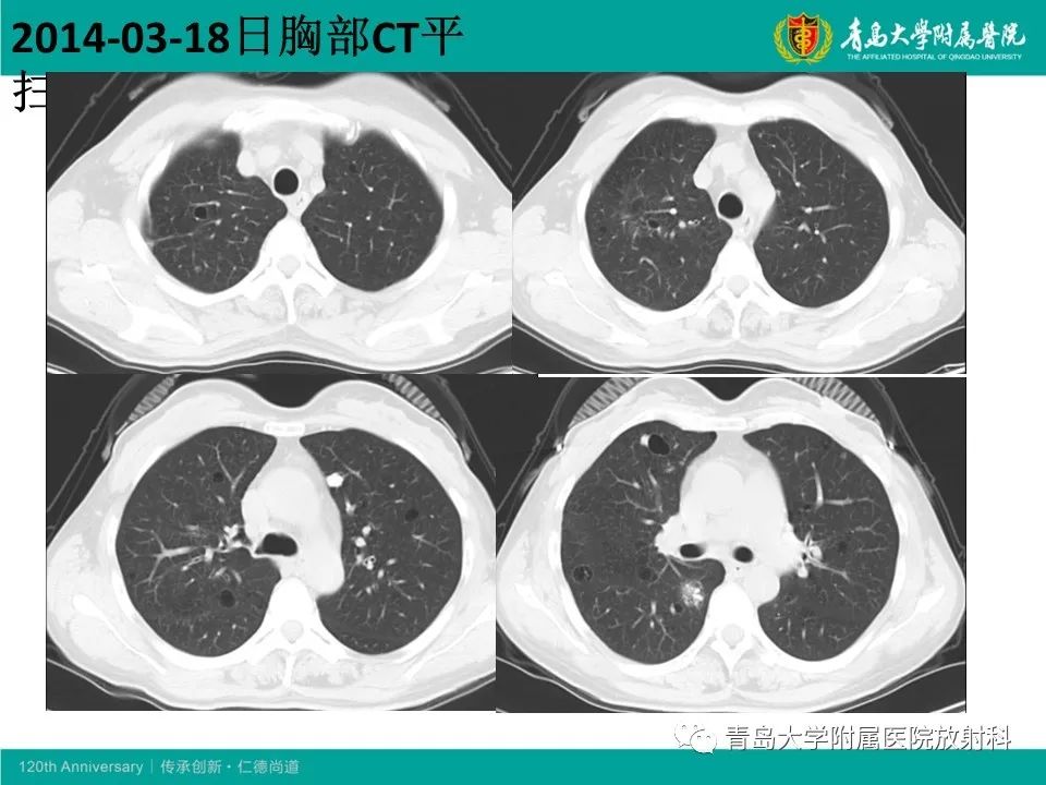 【病例】原发性干燥综合征继发肺淀粉样变性1例CT影像-5