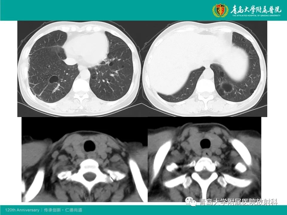【病例】原发性干燥综合征继发肺淀粉样变性1例CT影像-7