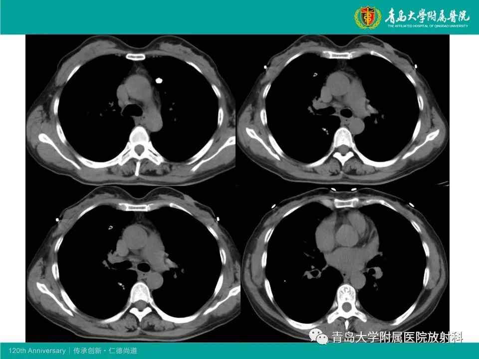 【病例】原发性干燥综合征继发肺淀粉样变性1例CT影像-8