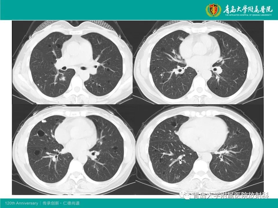 【病例】原发性干燥综合征继发肺淀粉样变性1例CT影像-6