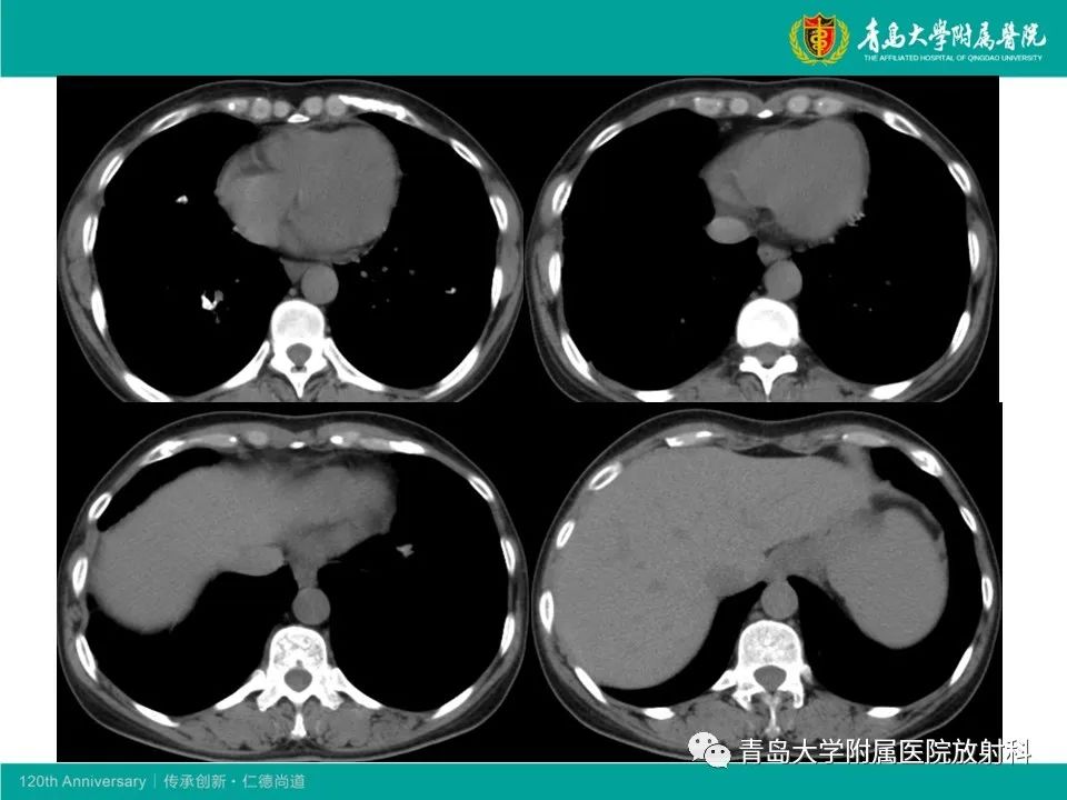 【病例】原发性干燥综合征继发肺淀粉样变性1例CT影像-9
