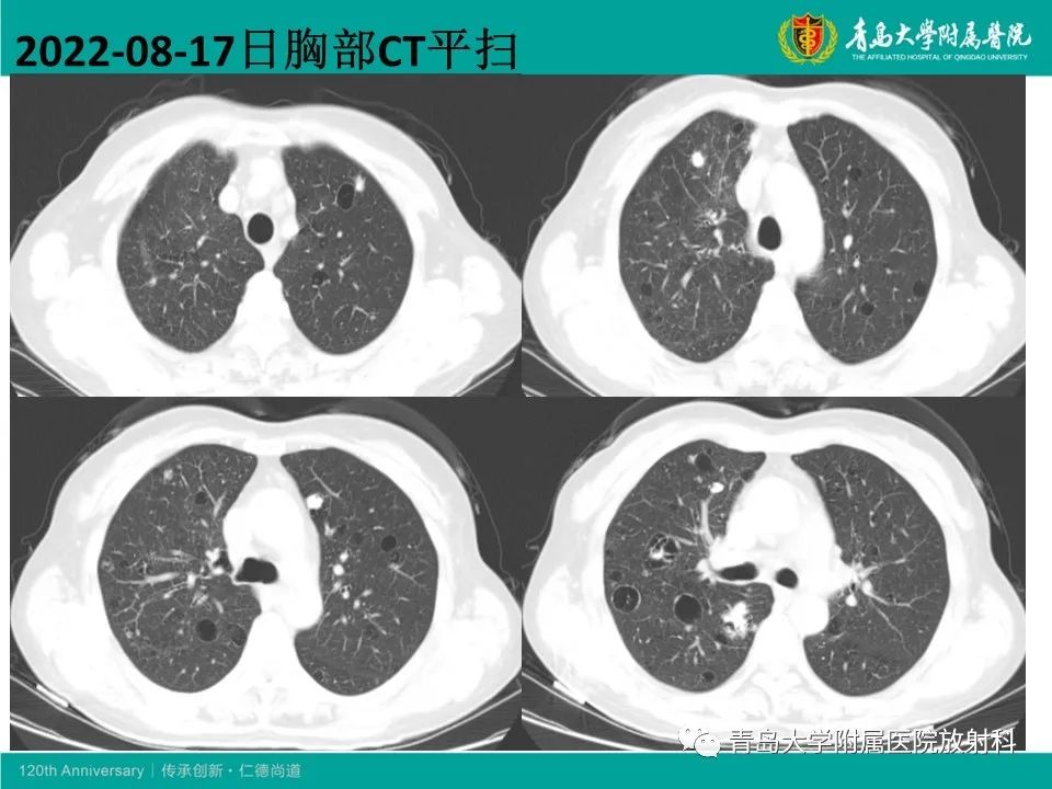 【病例】原发性干燥综合征继发肺淀粉样变性1例CT影像-10
