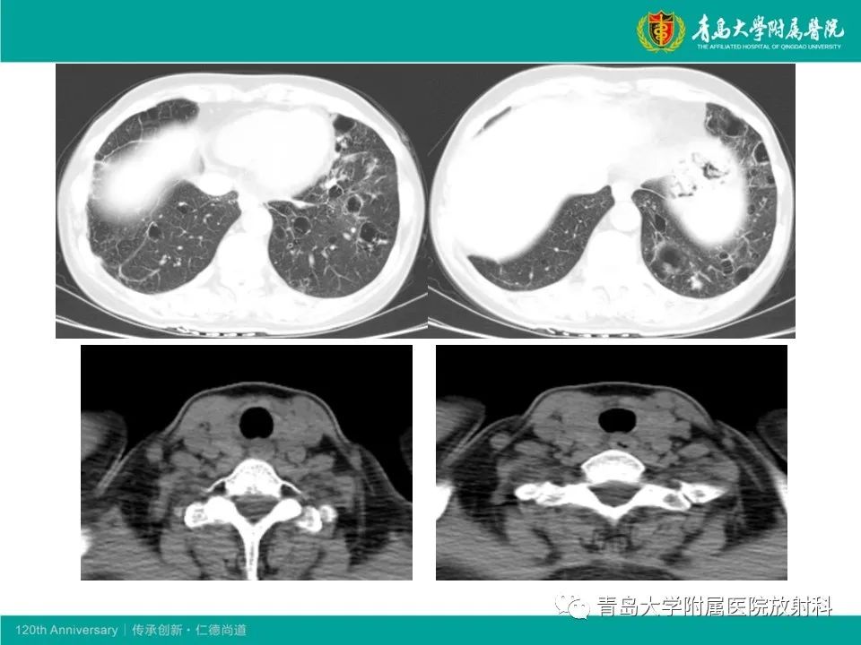 【病例】原发性干燥综合征继发肺淀粉样变性1例CT影像-12