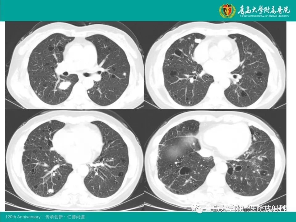 【病例】原发性干燥综合征继发肺淀粉样变性1例CT影像-11