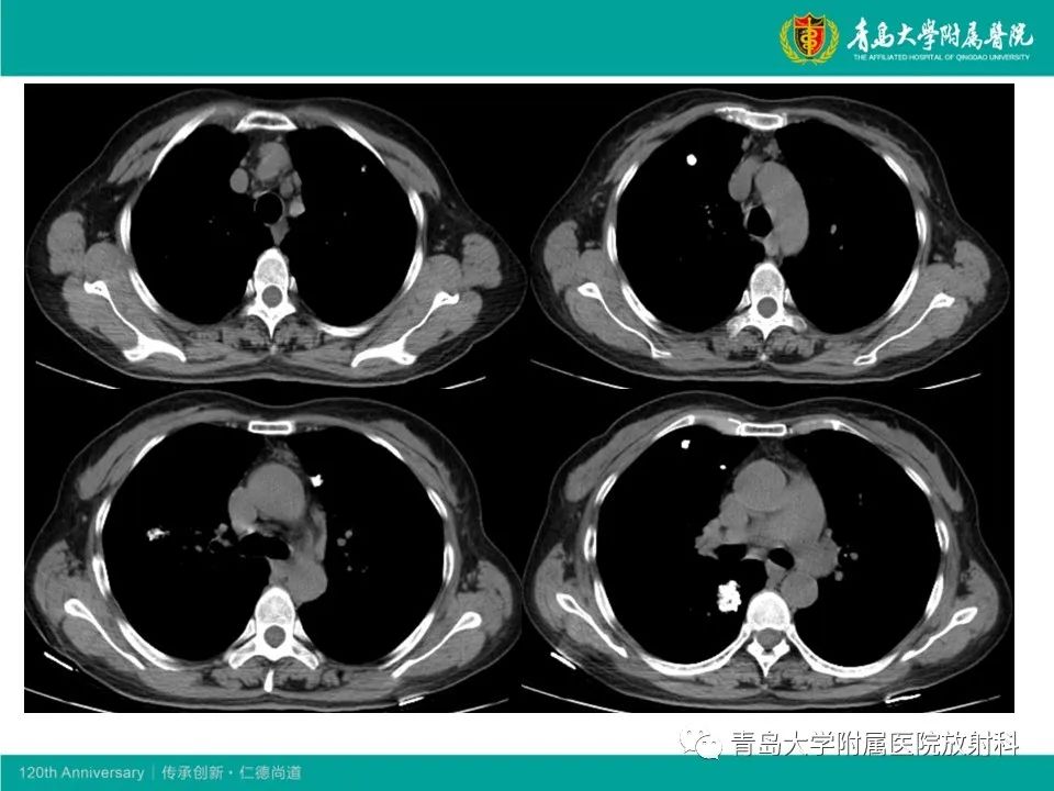 【病例】原发性干燥综合征继发肺淀粉样变性1例CT影像-13