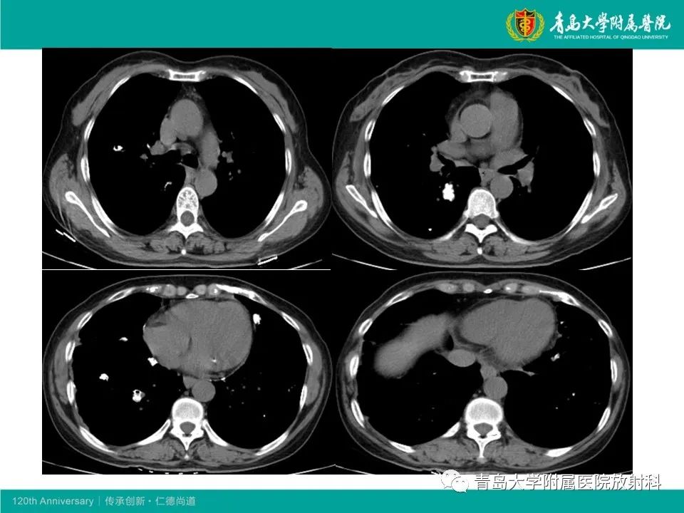 【病例】原发性干燥综合征继发肺淀粉样变性1例CT影像-14