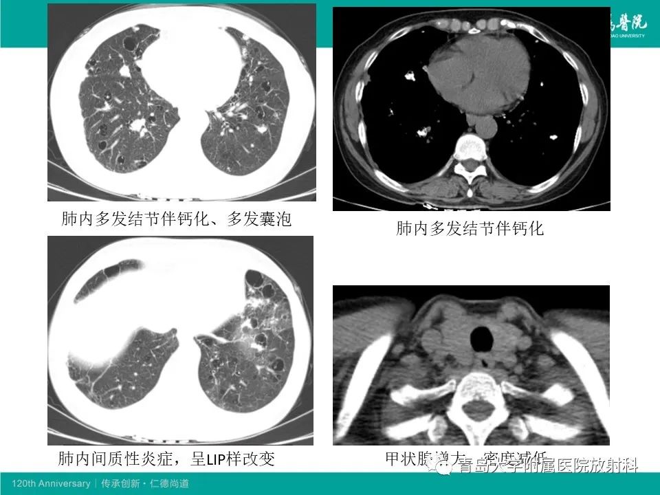【病例】原发性干燥综合征继发肺淀粉样变性1例CT影像-19