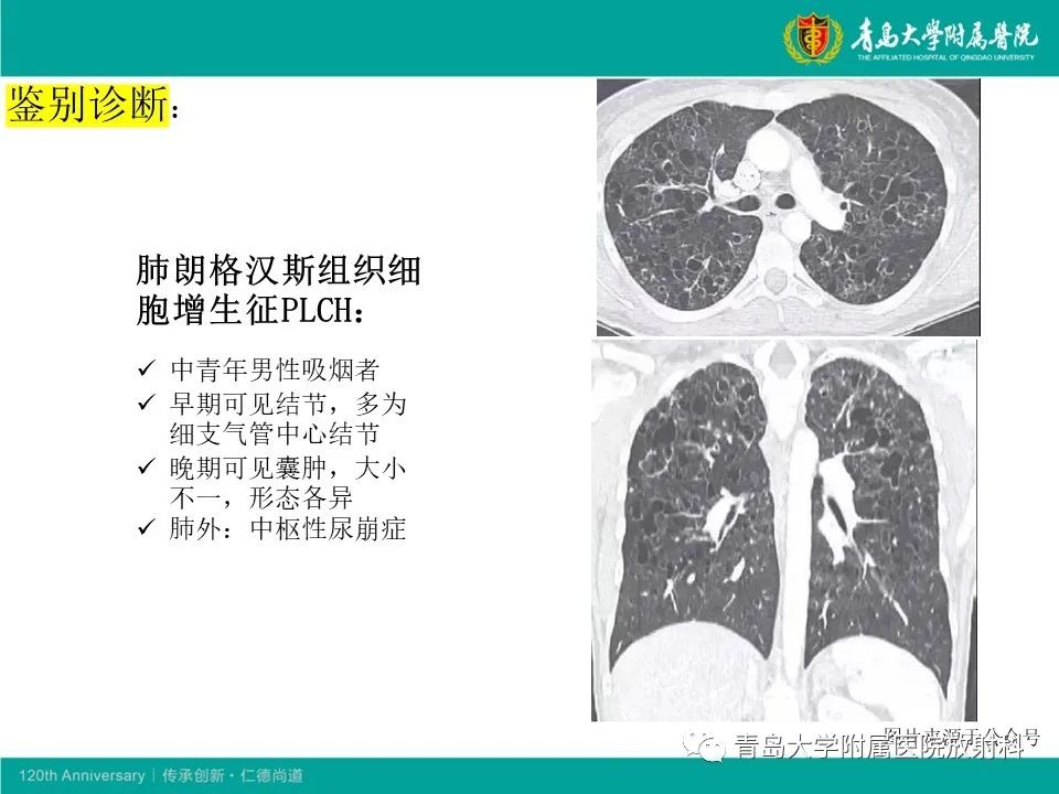 【病例】原发性干燥综合征继发肺淀粉样变性1例CT影像-21