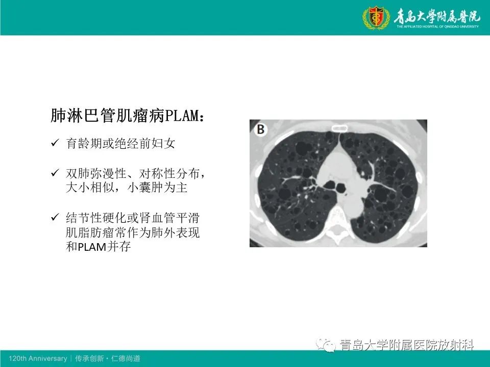 【病例】原发性干燥综合征继发肺淀粉样变性1例CT影像-22