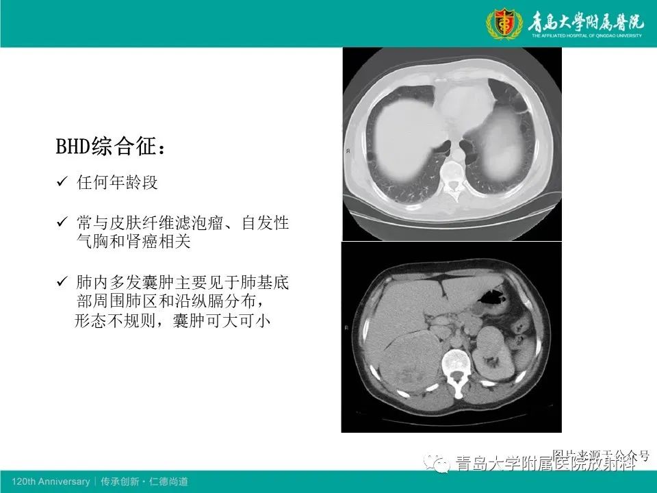 【病例】原发性干燥综合征继发肺淀粉样变性1例CT影像-23