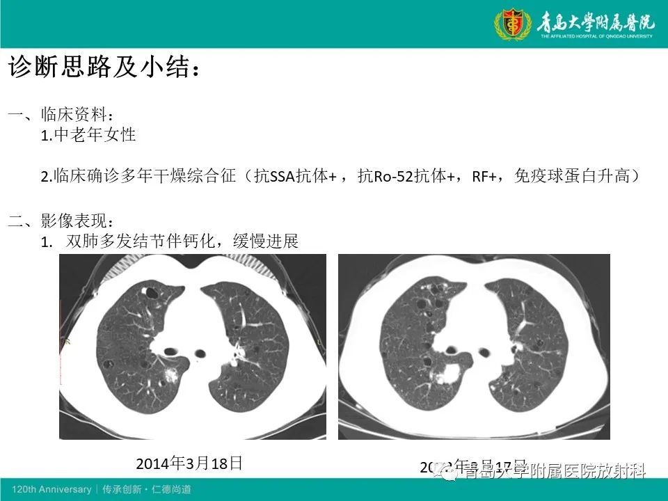 【病例】原发性干燥综合征继发肺淀粉样变性1例CT影像-25