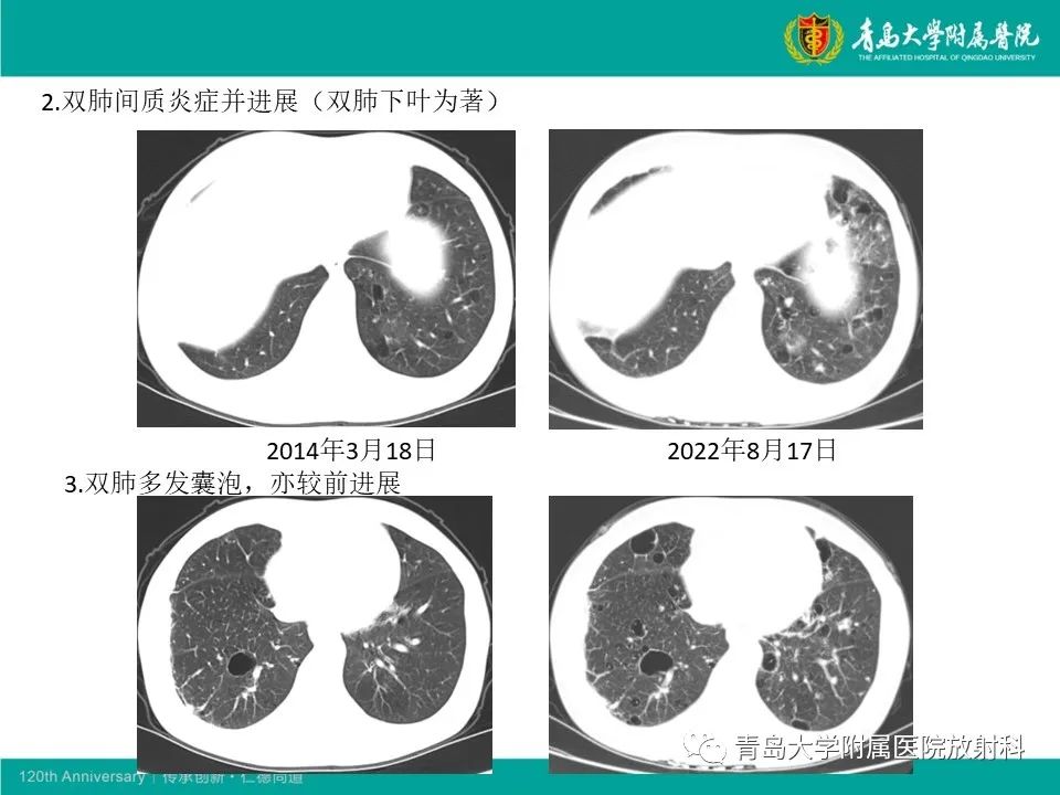 【病例】原发性干燥综合征继发肺淀粉样变性1例CT影像-26