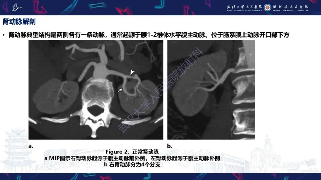 【PPT】肾动脉：解剖、病理及血管内治疗-4